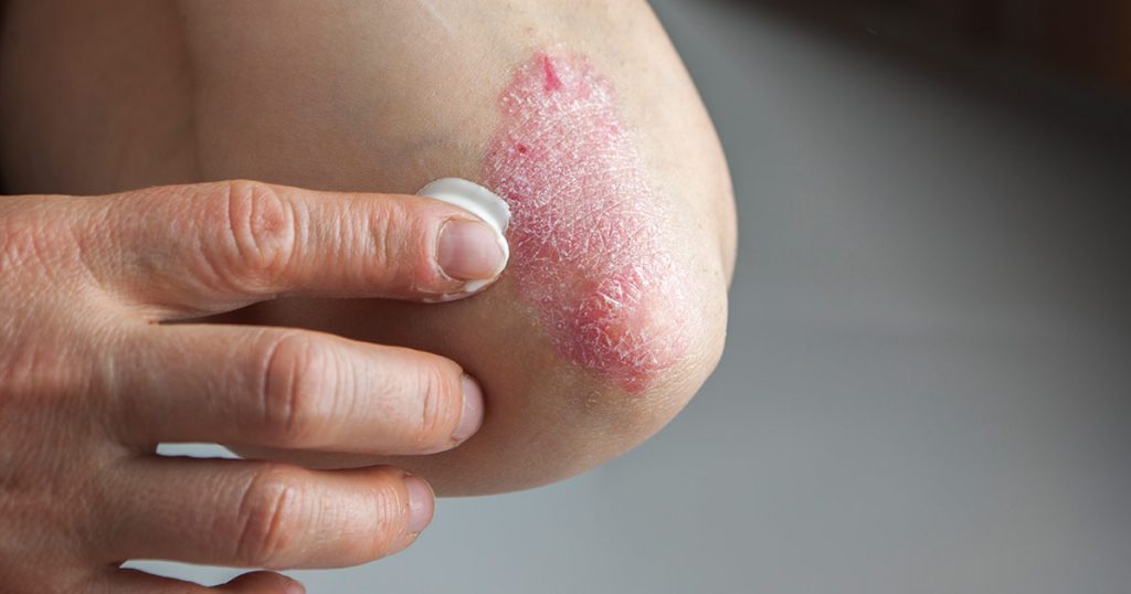 10 stvari koje bi svi trebali znati o psorijazi